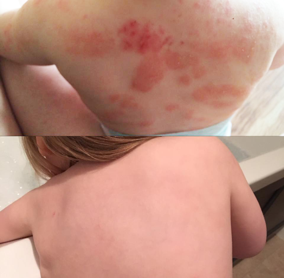 Example of how ENJO helped to clear eczema from a childs skin
